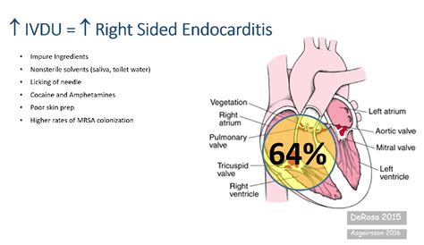 Combating The Crisis Not Your Oslers Endocarditis Anymore — Downeast
