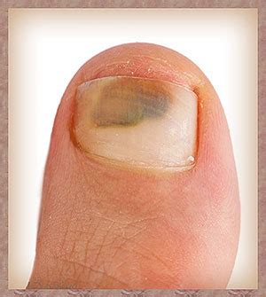 I had a dark brown spot under my foot and was very small and look like a callus but now i have like four more and was wondering what it can be? answered by dr. dark spots on toenails - DriverLayer Search Engine