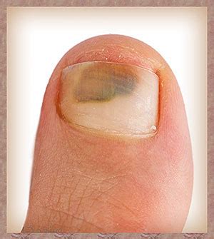 Search for instant quality results at helping.com. Nail Fungus Research | Global Nail Fungus Organization ...