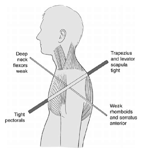 Better Posture Understanding Jandas Syndromes Whole