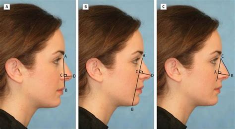 Nasal Tip Rotation Of 106 Degrees Considered The Most Aesthetic In