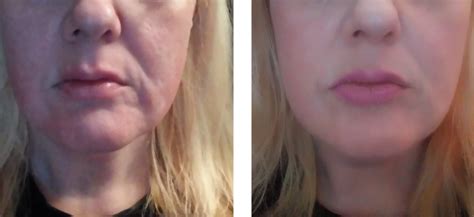 Radio Frequency Face Treatment Before And After Your Magazine Lite