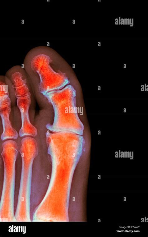 Deformed Toe Bones Hi Res Stock Photography And Images Alamy