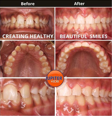 Braces Before And After Smile