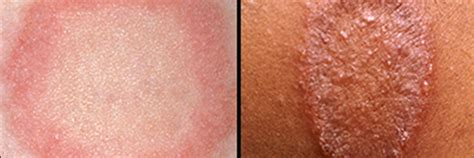 Ringworm Vs Psoriasis Diagnosing The Difference Skin And Hair Academy