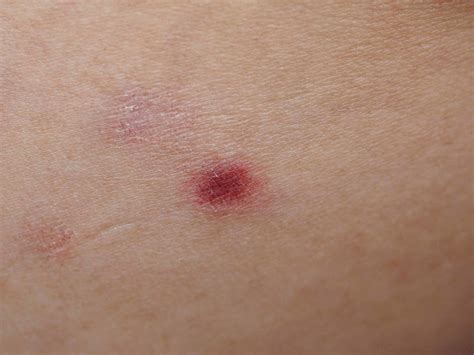 Cureus Clinical Dermatoscopic And Histological Findings In A Diagnosis Of Pityriasis Lichenoides