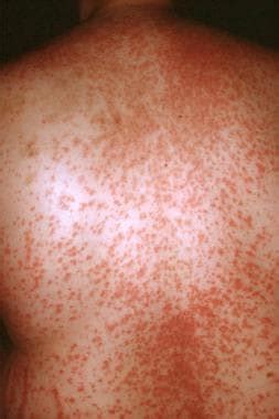View Allergic Reaction Skin Rash During Tb Treatment Khowarnewall
