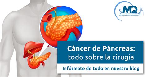 Cáncer De Páncreas Todo Sobre La Cirugía