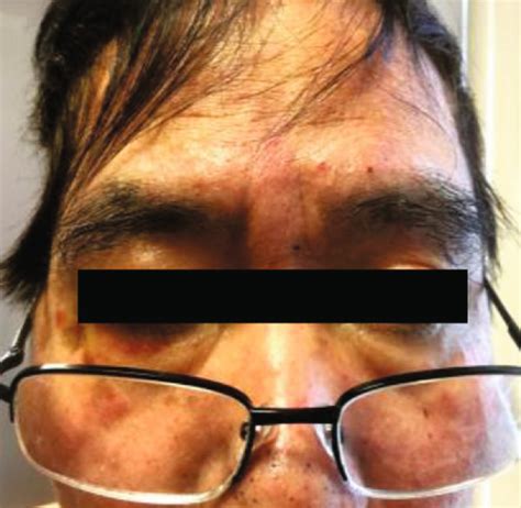 Papular Rash With Erythematous Base A On The Face B On The Lower