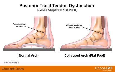 Posterior Tibial Tendonitis Foot Pain Explored Art Kk