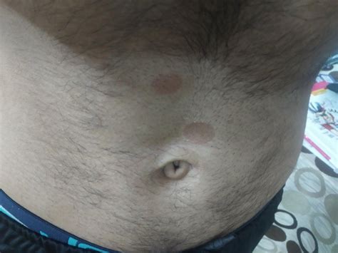 I Got Two Round Shaped Spots Around My Abdominal They Are Not Itchy