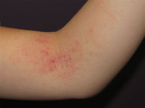 Hives Skin Rashes Itchy