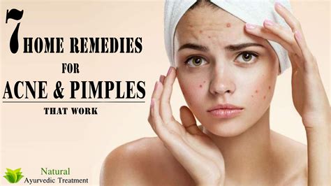 7 Home Remedies For Acne And Pimples That Work