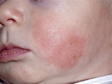 Childhood Rashes And Skin Conditions Babycenter Canada