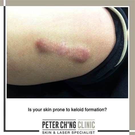4 Steps To Prevent A Keloid Scar Formation Peter Chng Skin