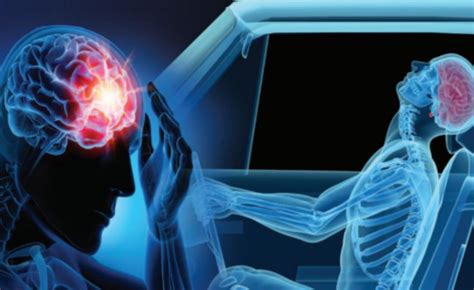 Understanding A Concussion In The Wake Of A Car Accident Xcell