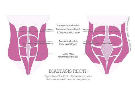 Understanding Diastasis Recti Niix