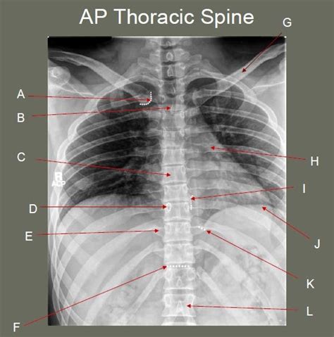 Ap Thoracic Spine Mayo Radiograph Diagram Quizlet