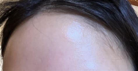 Skin Concerns Bumps On Forehead Spreading Skincareaddiction