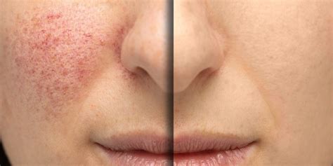 Red Thread Vein Treatments For Face And Legs At Cheshire Lasers Clinic