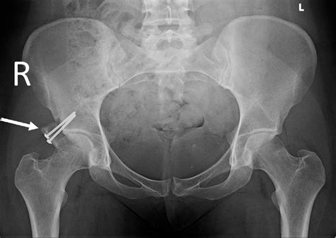 Anteroposterior Pelvis Postoperative X Ray Showing Final Result On The