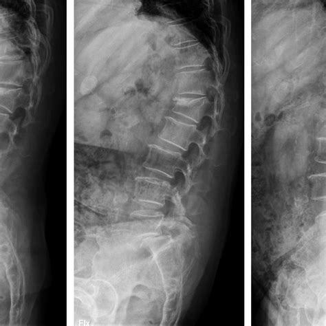 Preoperative Plain Radiographs A Standing Lateral View B