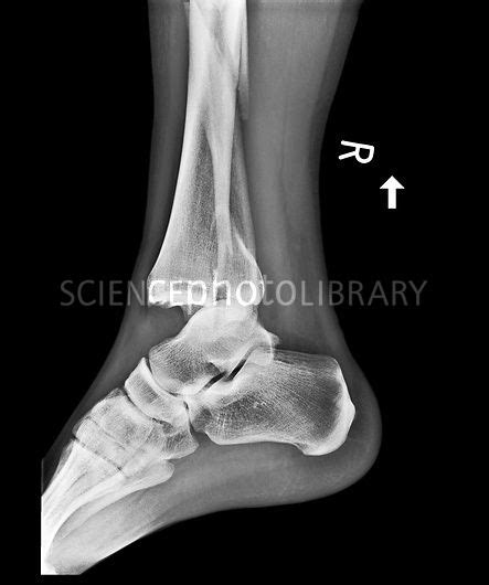 Fractured And Dislocated Ankle X Ray Stock Image C0177976