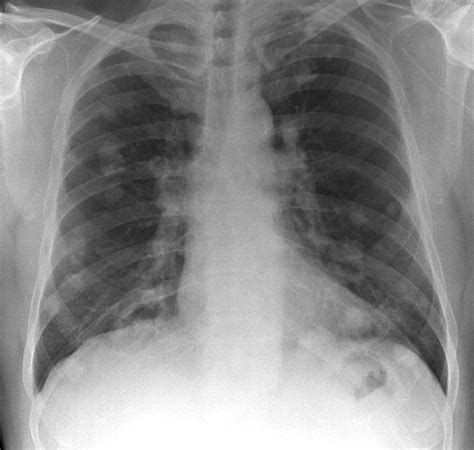 Lung Cancer X Ray Photograph By Du Cane Medical Imaging Ltd