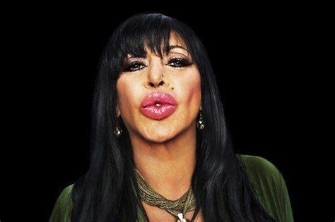 Top 5 Bad Lip Injections Before And After Photos Bad Lip Injections Big Ang Lip Injections