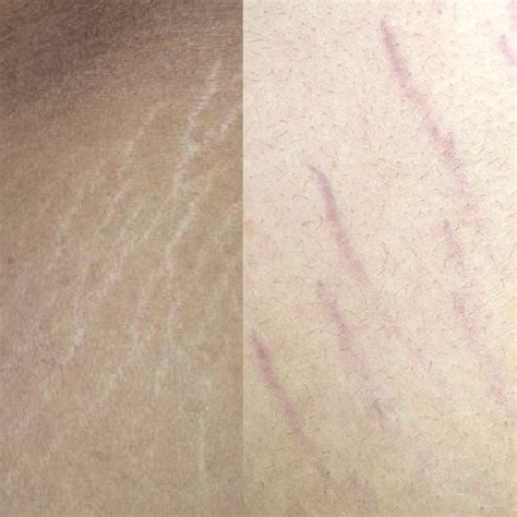 Stretch Marks Red Vs White Vancouver Permanent Makeup