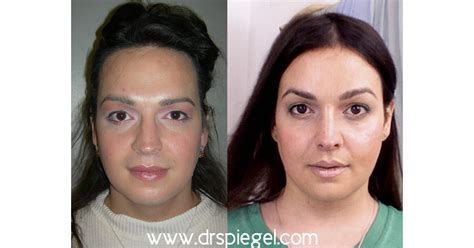 9 Sex Reassignment Surgery A Transgender Woman Who Is Also