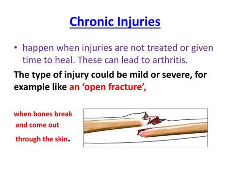 Ppt Year 11 Gcse Pe Sports Injuries Powerpoint Presentation Free