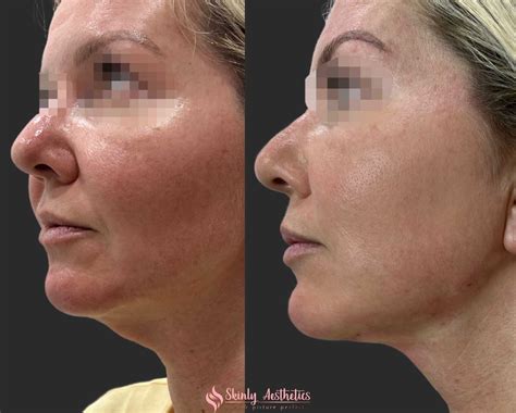 Pdo Thread Lifting Before And After Results At Skinly Aesthetics
