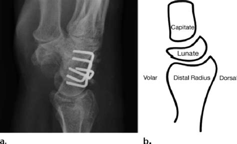 Normal Carpal Alignment In Four Corner Arthrodesis Lateral Radiograph