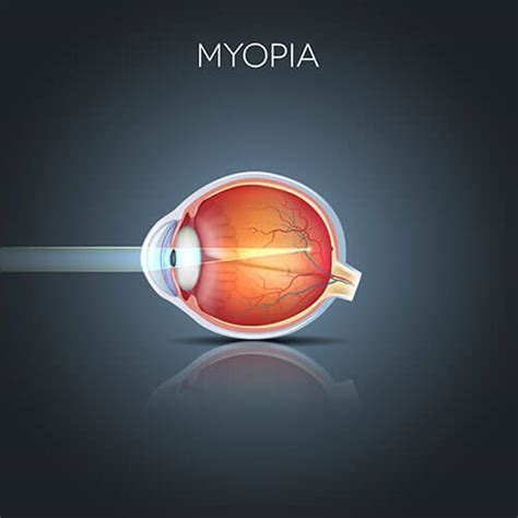 Chart Illustrating How Myopia Affects An Eye