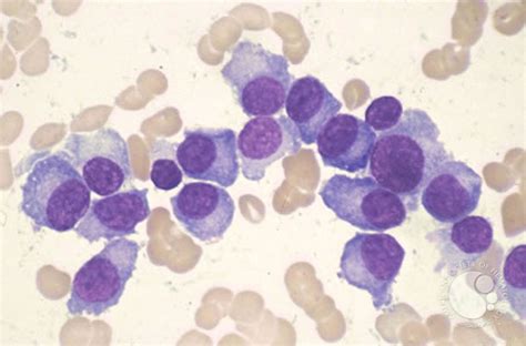 Plasma Cell Leukemia 1