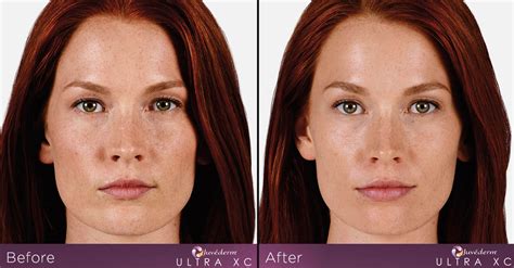 Juvederm Ultra And Ultra Plus Xc Treatments Smooth Synergy Medical Spa