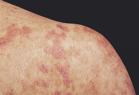 Lichenoid Dermatitis In Paraneoplastic Pemphigus A Pathogenic Trigger