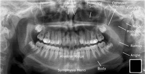 Radiographic Anatomy Of Facial Bones And Mandible With Radiological