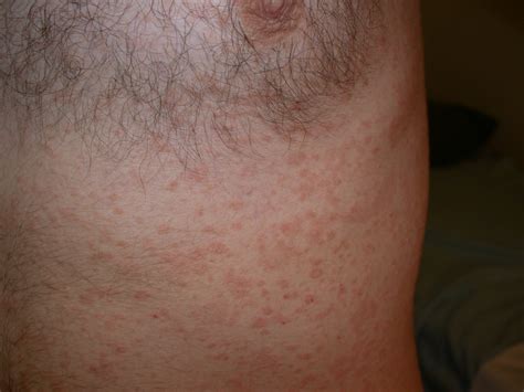 Pityriasis Rosea Stages Symptoms Causes Treatment And Prevention Of Images
