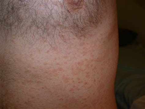 Also, if you're pregnant, you may need close follow up. Pityriasis Rosea Skin Rash Photos Christmas Tree | Dark ...