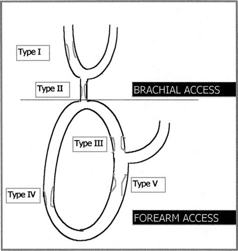 Stenosis Classification Type I Brachial Access Stenosis Upstream Or