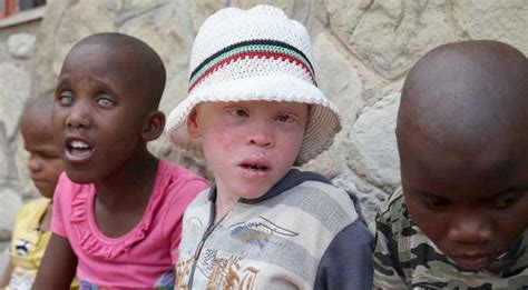 An Island Refuge For Tanzanias Albinos World News