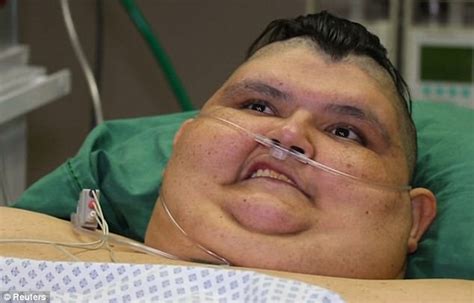 Worlds Fattest Man Loses 385 Pounds To Go Under Knife Daily Mail Online