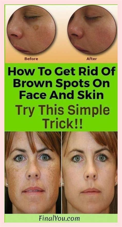 Simple Trick To Remove Brown Spots From Your Skin Brown Spots On Face Black Spots On Face