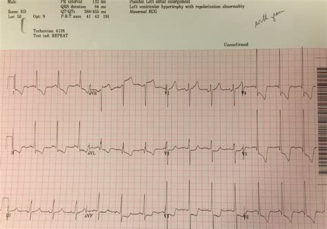 Dr Smiths Ecg Blog Lvh With Secondary St Depression