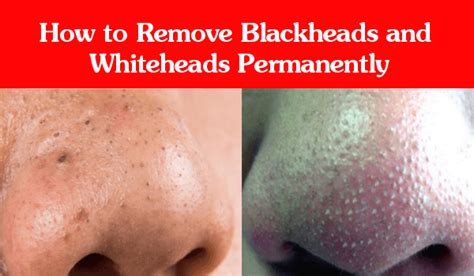 How To Remove Blackheads And Whiteheads Permanently Right Home Remedies