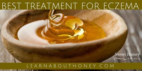 Best Treatment For Eczema Sweet Honey