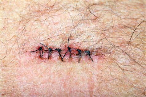 Stiched Incision From A Basal Cell Carcinoma Removal Stock Photo