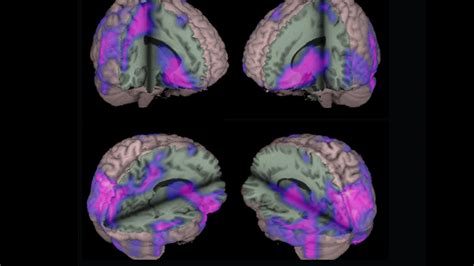 Brain Connectivity Study Could Lead to Better Outcomes for Epilepsy 